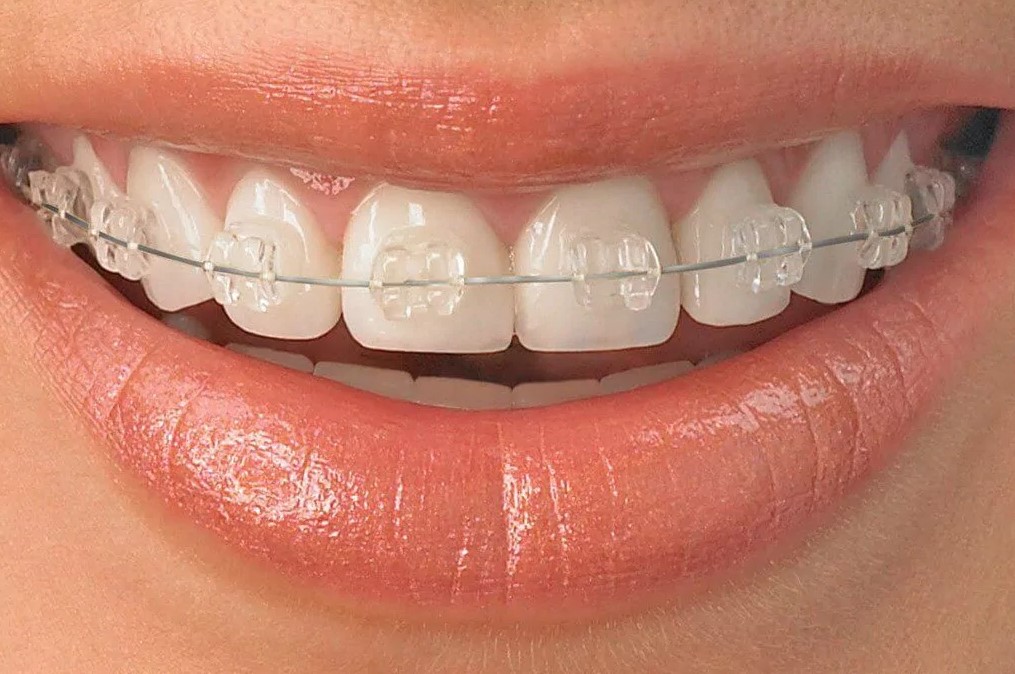 Woman's teeth with clear ceramic braces on their teeth.