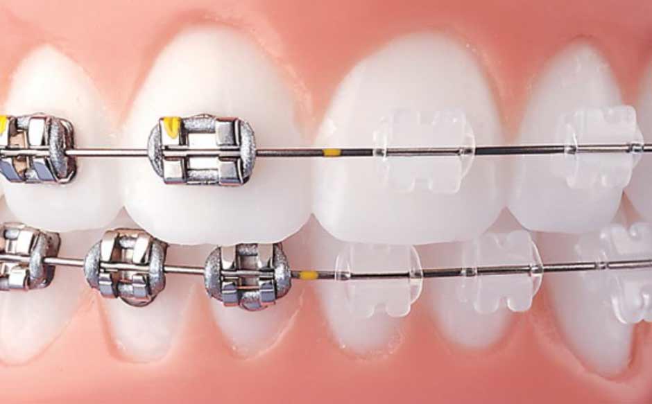 Ceramic and Metallic braces on teeth.