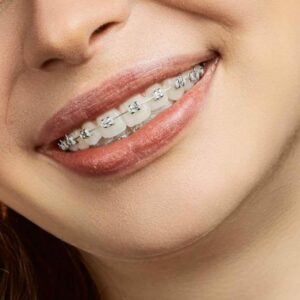 Metal Braces on woman's teeth