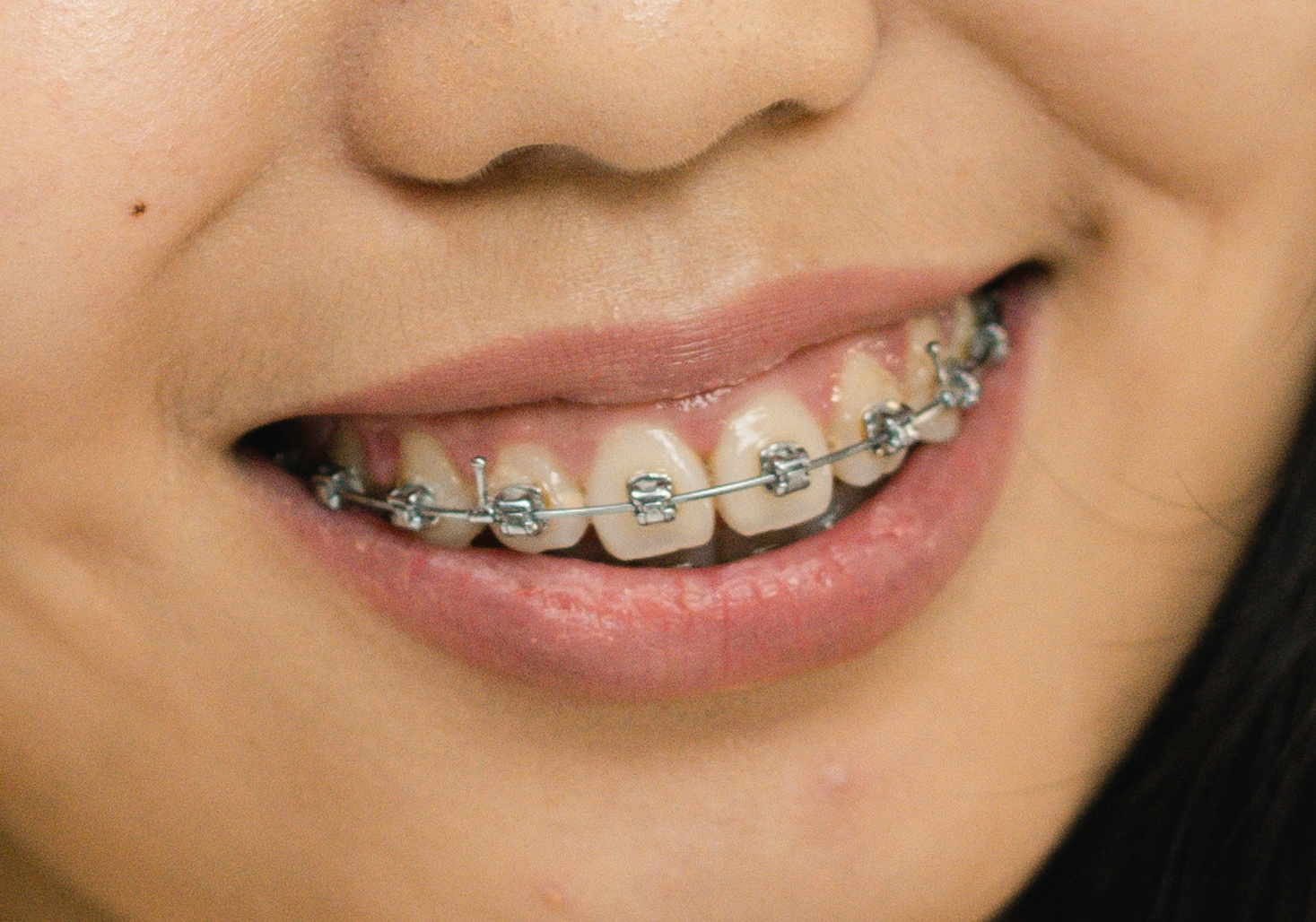 Metal vs Ceramic braces